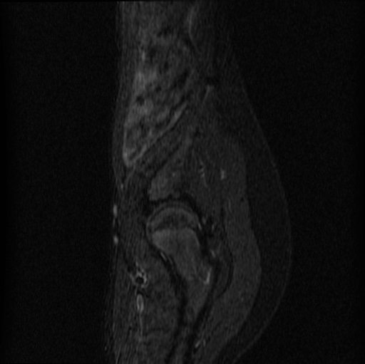 File:Aneurysmal bone cyst - sacrum (Radiopaedia 65190-74196 Sagittal STIR 4).jpg