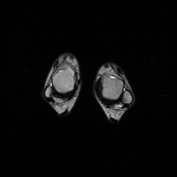 File:Aneurysmal bone cyst - tibia (Radiopaedia 22343-22367 Axial T2 18).jpg