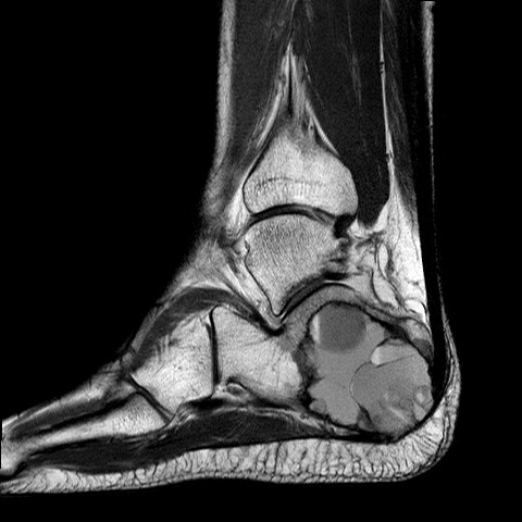 File:Aneurysmal bone cyst of the calcaneus (Radiopaedia 60669-68420 Sagittal PD 7).jpg