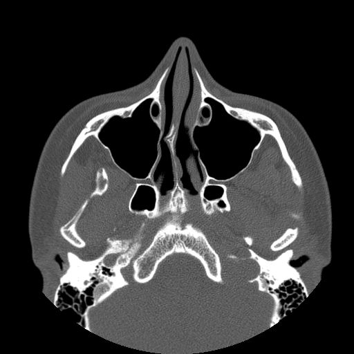 Aneurysmal bone cyst of the mandible (Radiopaedia 43280-46823 Axial bone window 135).jpg