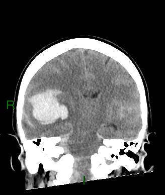 Aneurysmal subarachnoid hemorrhage with intra-axial extension (Radiopaedia 84371-99699 Coronal non-contrast 34).jpg