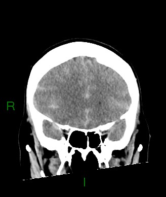 Aneurysmal subarachnoid hemorrhage with intra-axial extension (Radiopaedia 84371-99699 Coronal non-contrast 47).jpg