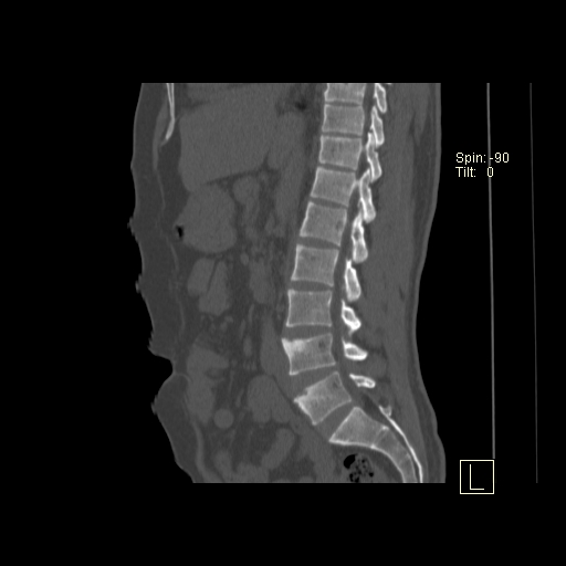 File:Ankylosing spondylitis (Radiopaedia 52728-58645 Sagittal bone window 12).jpg