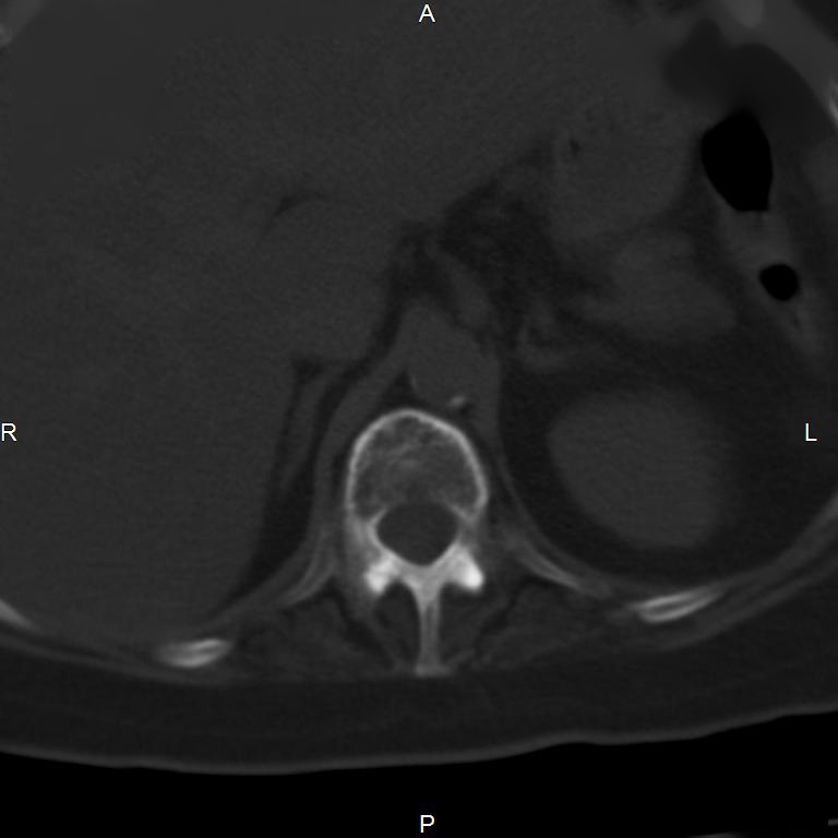 Ankylosing spondylitis (Radiopaedia 8748-9556 Axial bone window 16).jpg