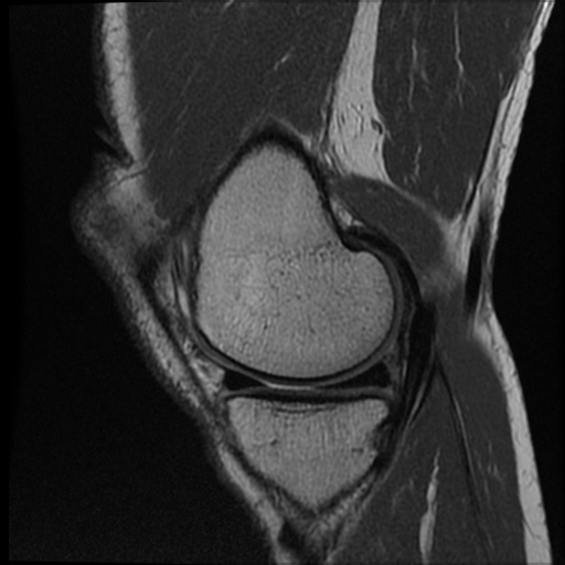 Anomalous insertion of the medial meniscus (Radiopaedia 77559-89721 Sagittal PD 40).jpg