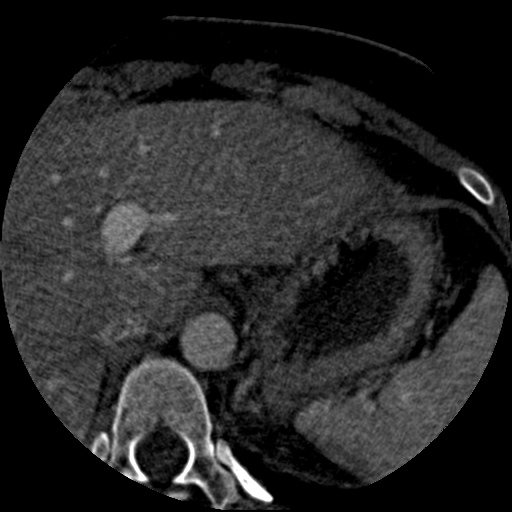 Anomalous left coronary artery from the pulmonary artery (ALCAPA) (Radiopaedia 40884-43586 A 94).jpg