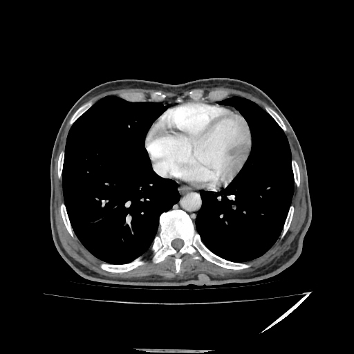 Anorectal carcinoma (Radiopaedia 44413-48064 A 1).jpg