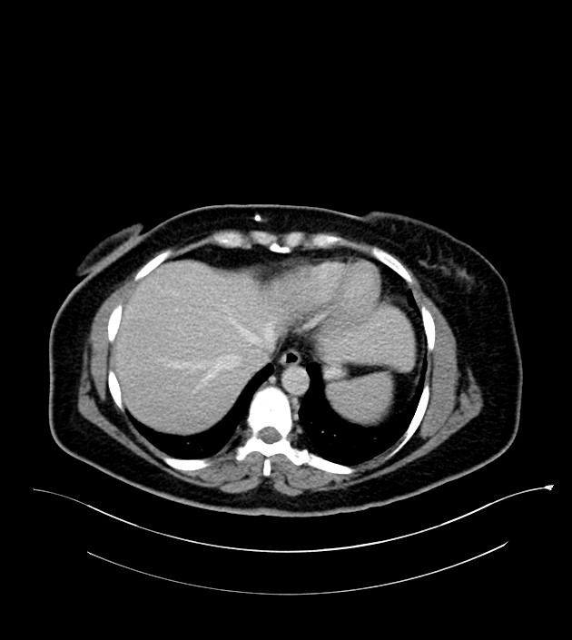 Anterior abdominal wall CSF pseudocyst (CSFoma) (Radiopaedia 79453-92571 A 15).jpg