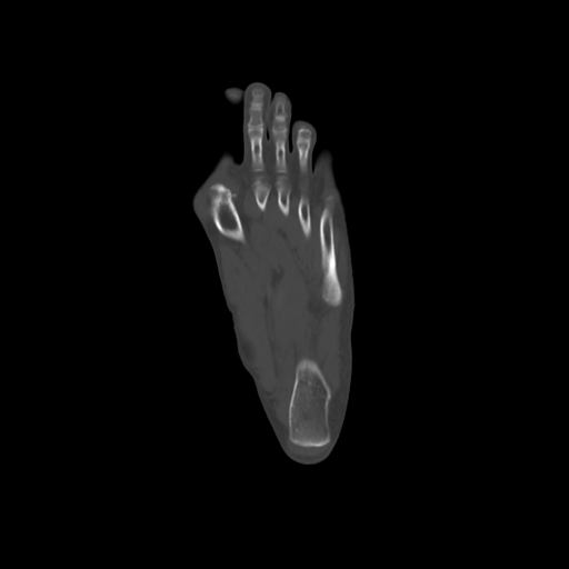 File:Anterior calcaneal process fracture (Radiopaedia 47384-51989 Sagittal bone window 1).png