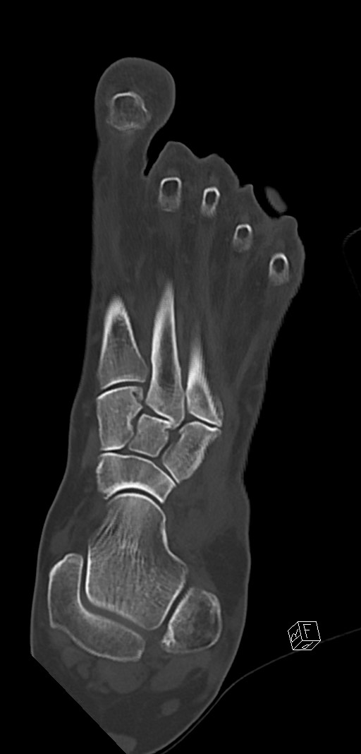 Anterior calcaneal process fracture (Radiopaedia 63353-71943 Coronal bone window 19).jpg