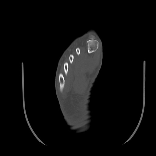 File:Anterior calcaneal process fracture (Radiopaedia 82590-96762 Axial bone window 38).jpg