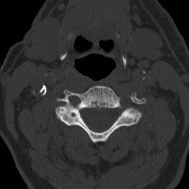 Anterior cervical postdiscectomy arthrodesis (Radiopaedia 32678-33646 Axial bone window 36).jpg