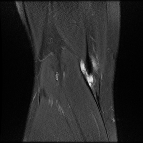 File:Anterior cruciate ligament graft tear and bucket-handle tear of medial meniscus (Radiopaedia 75867-87254 Coronal PD fat sat 23).jpg
