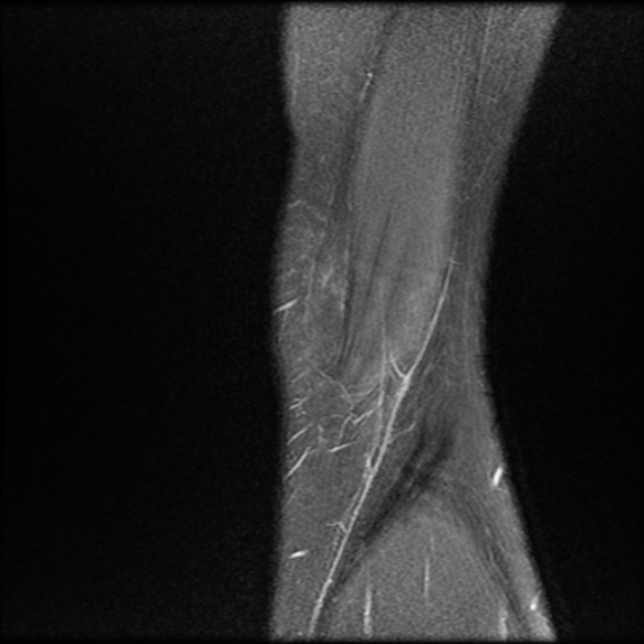 File:Anterior cruciate ligament graft tear and bucket-handle tear of medial meniscus (Radiopaedia 75867-87254 Sagittal PD fat sat 1).jpg