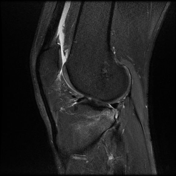 File:Anterior cruciate ligament graft tear and bucket-handle tear of medial meniscus (Radiopaedia 75867-87254 Sagittal PD fat sat 19).jpg