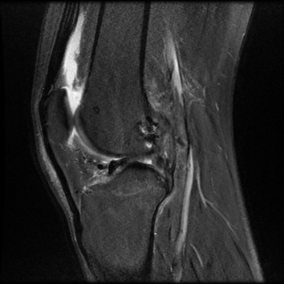 File:Anterior cruciate ligament graft tear and bucket-handle tear of medial meniscus (Radiopaedia 75867-87255 Sagittal PD fat sat 17).jpg