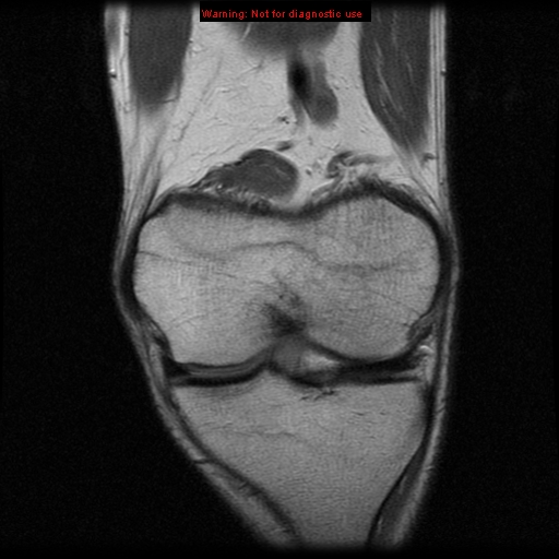 File:Anterior cruciate ligament injury - partial thickness tear (Radiopaedia 12176-12515 D 3).jpg