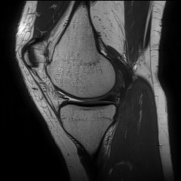Anterior cruciate ligament rupture and posteromedial corner injury (Radiopaedia 67338-76723 Sagittal PD 59).jpg