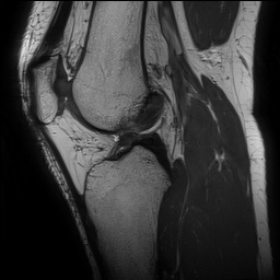 Anterior cruciate ligament rupture and posteromedial corner injury (Radiopaedia 67338-76723 Sagittal PD 93).jpg