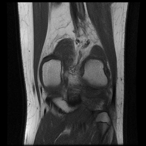 File:Anterior cruciate ligament tear (Radiopaedia 61500-69462 Coronal T1 16).jpg