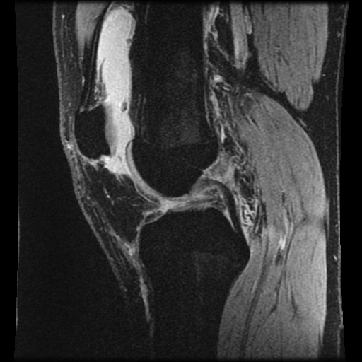 Anterior cruciate ligament tear (Radiopaedia 61500-69462 F 40).jpg