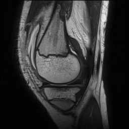 Anterior cruciate ligament tear - pediatric (Radiopaedia 62152-70260 Sagittal PD 53).jpg