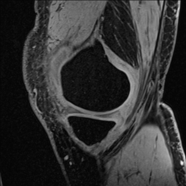 Anterior cruciate ligament tear - ramp lesion (Radiopaedia 71883-82322 Sagittal T1 vibe 110).jpg