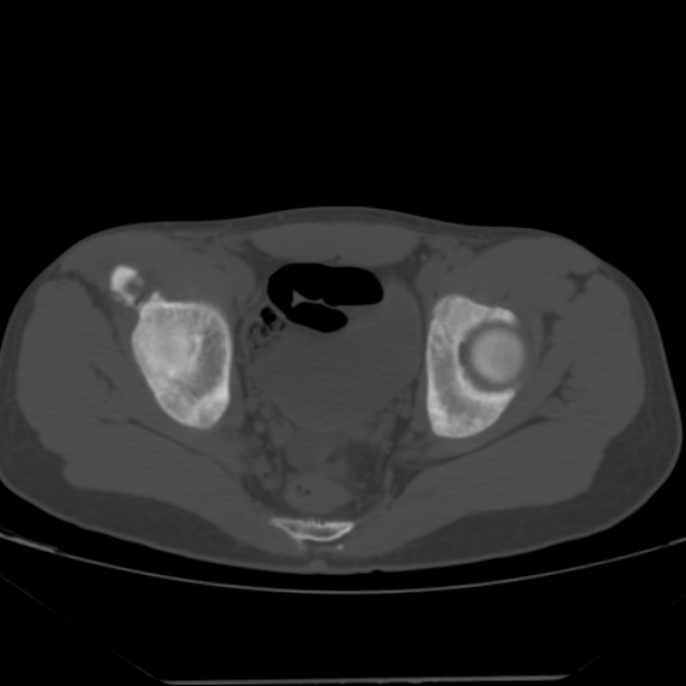 Anterior inferior iliac spine avulsion fracture (Radiopaedia 49469-54627 Axial bone window 34).jpg