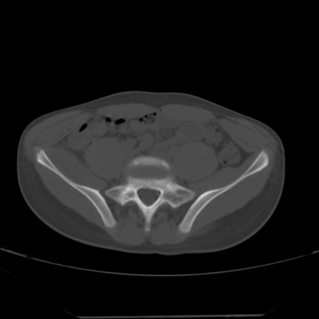 Anterior inferior iliac spine avulsion fracture (Radiopaedia 49469-54627 Axial bone window 5).jpg