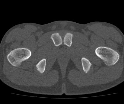 Anterior inferior iliac spine avulsion fracture (Radiopaedia 81312-94999 Axial bone window 65).jpg