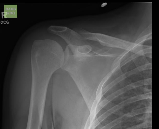 File:Anterior shoulder dislocation (Radiopaedia 11194-39053 Frontal 1).jpg