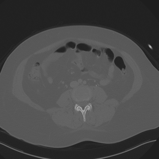 File:Anterior superior iliac spine avulsion fracture (Radiopaedia 44541-48244 Axial bone window 57).png