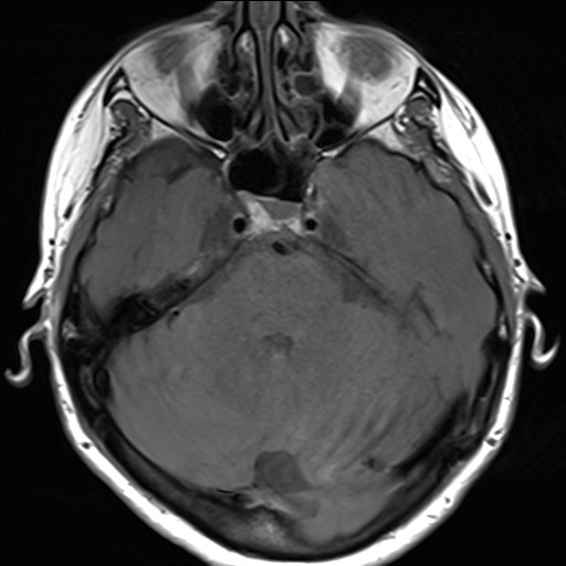 File:Anterior temporal encephalocele (Radiopaedia 82624-96808 Axial T1 10).jpg