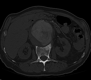 File:Anterior vertebral scalloping (abdominal aortic aneurysm) (Radiopaedia 66744-76067 Axial bone window 19).jpg