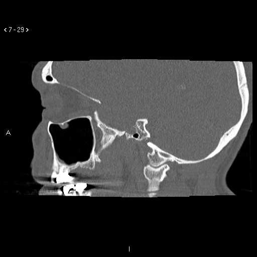 File:Antrochoanal Polyp (Radiopaedia 70510-80631 Sagittal bone window 19).jpg