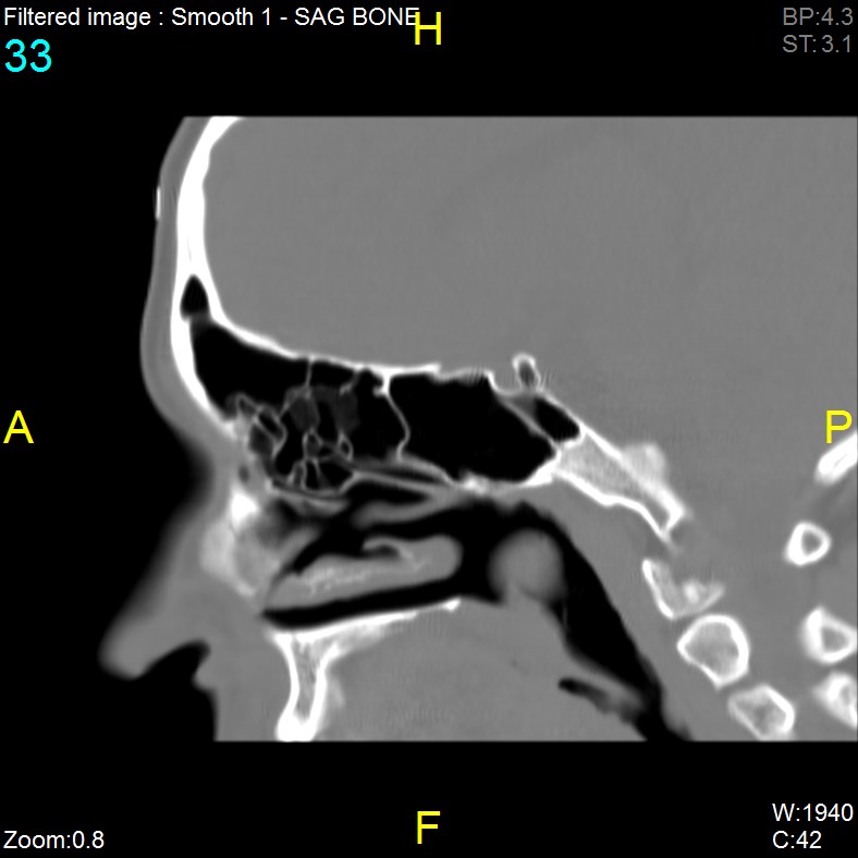 Antrochoanal polyp (Radiopaedia 65101-74094 Sagittal bone window 33).jpg