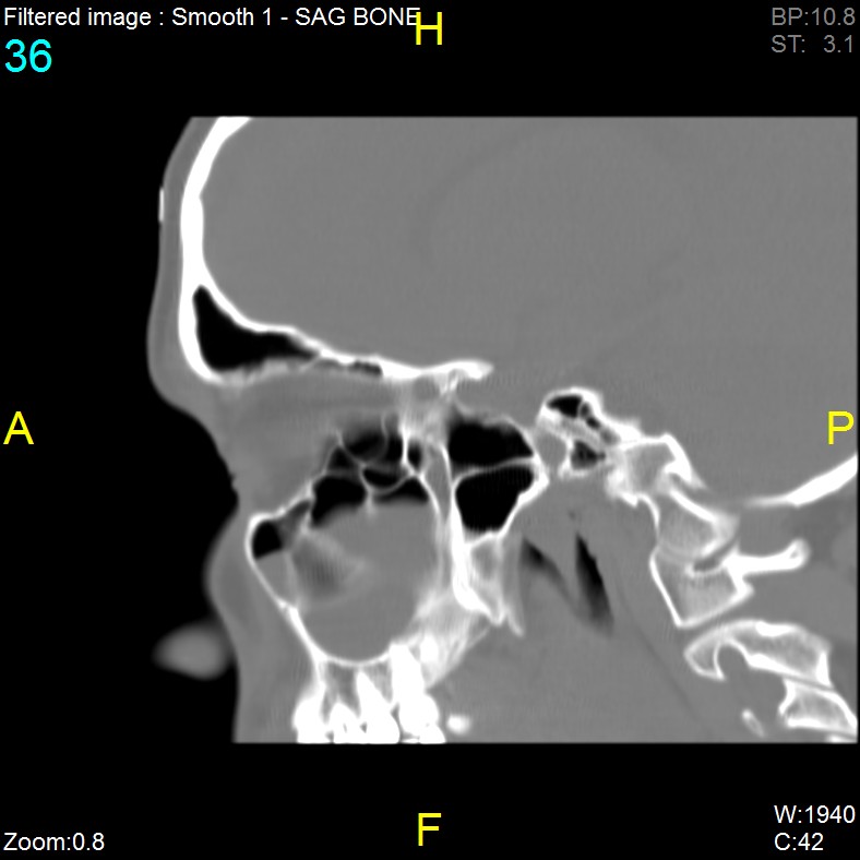 Antrochoanal polyp (Radiopaedia 65101-74094 Sagittal bone window 36).jpg