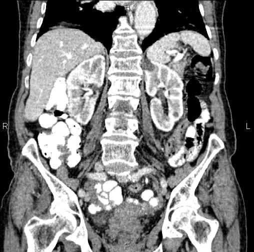 Aortic aneurysm and Lemmel syndrome (Radiopaedia 86499-102554 C 39).jpg