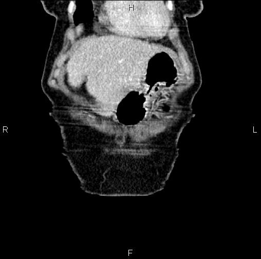 Aortic aneurysm and Lemmel syndrome (Radiopaedia 86499-102554 C 5).jpg