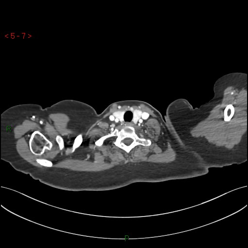 File:Aortic arch origin of left vertebral artery (Radiopaedia 51520-57286 A 6).jpg