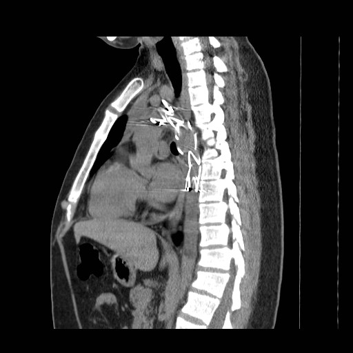 File:Aortic arch stent (Radiopaedia 30030-30595 B 10).jpg