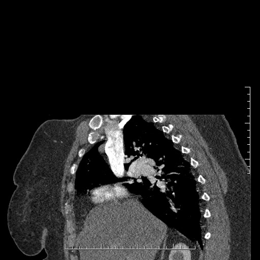 File:Aortic dissection- Stanford A (Radiopaedia 35729-37268 D 47).jpg