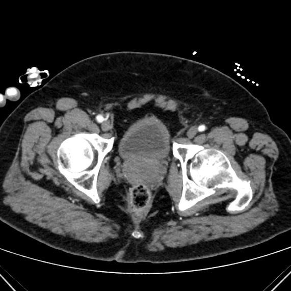 File:Aortic dissection- Stanford type A (Radiopaedia 39094).jpg