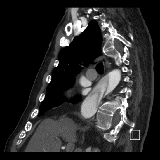 File:Aortic dissection (CTPA) (Radiopaedia 75506-86750 C 44).jpg