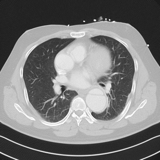 File:Aortic dissection (Radiopaedia 50763-56234 Axial lung window 35).png