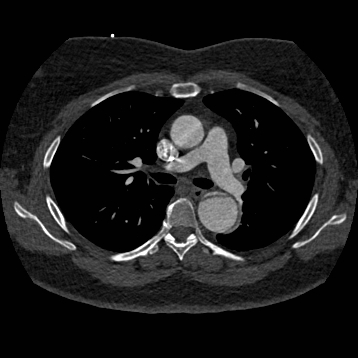 Aortic dissection (Radiopaedia 57969-64959 A 133).jpg