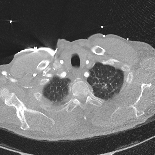 File:Aortic dissection - DeBakey type II (Radiopaedia 64302-73082 Axial lung window 8).png