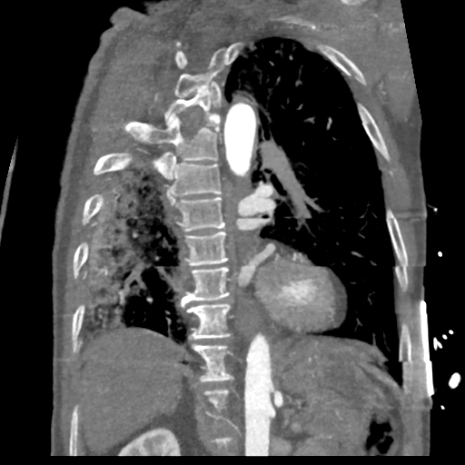 File:Aortic dissection - DeBakey type II (Radiopaedia 64302-73082 D 25).png