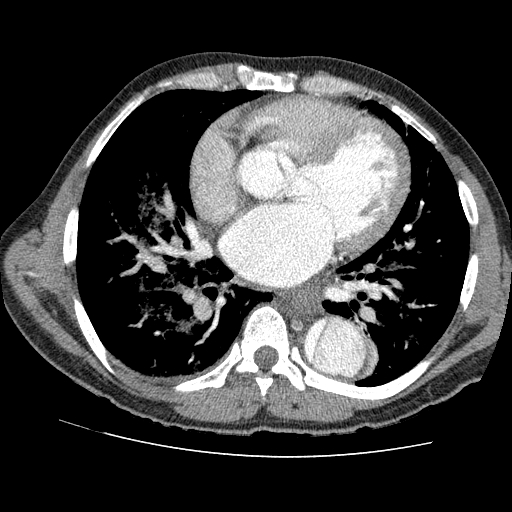 File:Aortic dissection - Stanford A -DeBakey I (Radiopaedia 28339-28587 B 56).jpg