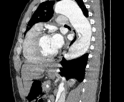 Aortic dissection - Stanford A -DeBakey I (Radiopaedia 28339-28587 C 53).jpg
